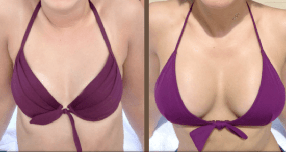 Преди и след операция за уголемяване на гърдите