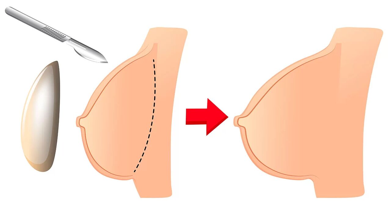 Уголемяване на бюста с имплант