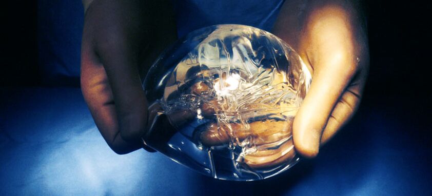 Силиконова ендопротеза